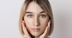 Почему стресс и нарушение сна могут вызывать акне