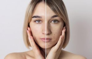 Почему стресс и нарушение сна могут вызывать акне