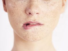 Что нужно знать о лазерной эпиляции при гиперпигментации и склонности к рубцеванию